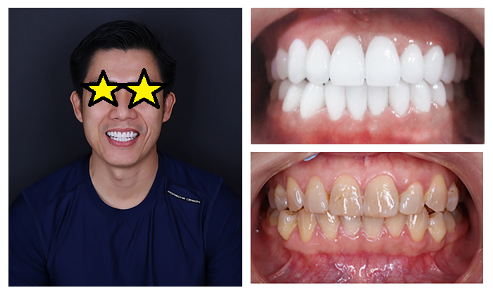 lam lai rang su ZAVATESLA Bọc Răng Sứ Có Đau Không? Sự Thật Đằng Sau Nỗi Lo Của Khách Hàng bọc răng sứ bọc răng sứ