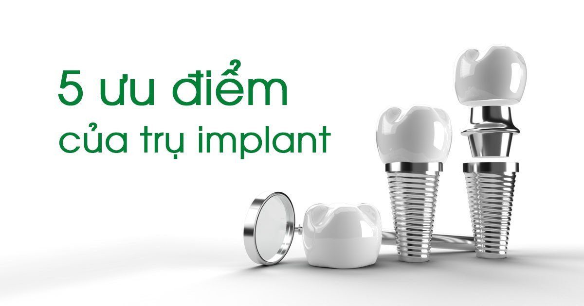 5 uu diem cua tru implant ZAVATESLA Trồng Răng Implant Là Gì? Những Kiến Thức Cần Biết Trước Khi Cấy Ghép Implant trồng răng implant trồng răng implant