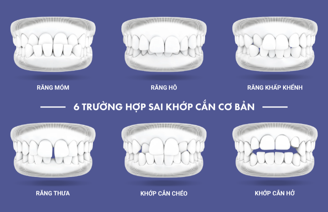 truong hop nen nieng rang 2 ZAVATESLA Niềng Răng Là Gì? Những Kiến Thức Cần Biết Trước Khi Niềng Răng niềng răng niềng răng