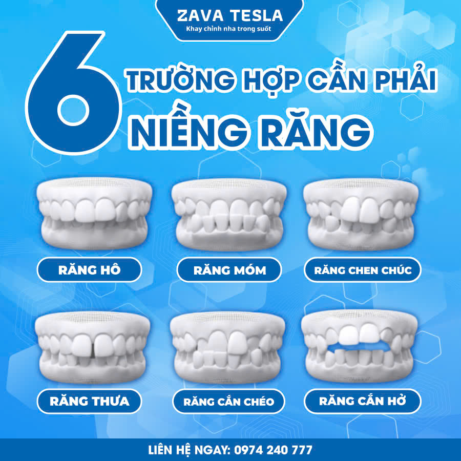 z6453757652230 492c38c3c77fb8c6bbb28016f60446c6 ZAVATESLA Khay Chỉnh Nha Trong Suốt – Giải Pháp Niềng Răng Thẩm Mỹ Hiện Đại khay chỉnh nha trong suốt khay chỉnh nha trong suốt