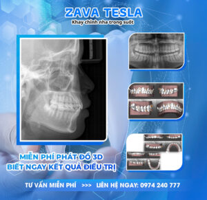 z6472097039557 cd934af957e6a733882776f1cf7fcd2c ZAVATESLA Niềng Răng Trong Suốt - Giải Pháp Thẩm Mỹ, Hiệu Quả và Cá Nhân Hóa Từ Zava Tesla niềng răng